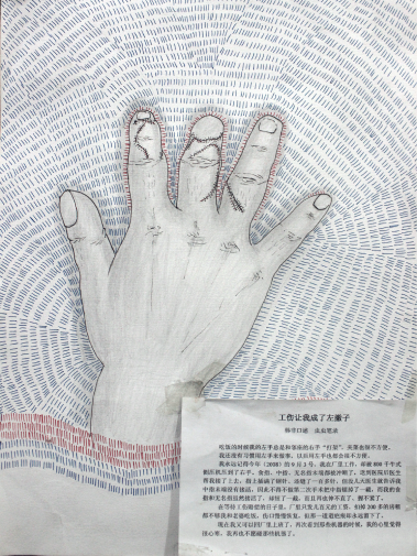 工伤让我成了左撇子